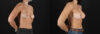 Breast Augmentation case #6378 slider thumbnail