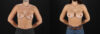 Breast Augmentation case #6378 slider thumbnail