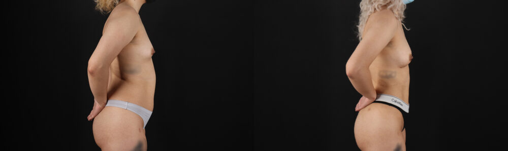 Liposuction case #6020