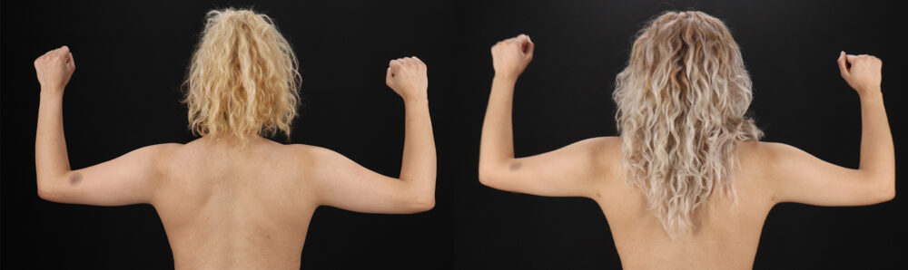 Liposuction case #6020