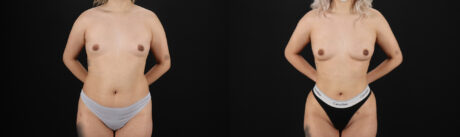 Liposuction case #6020