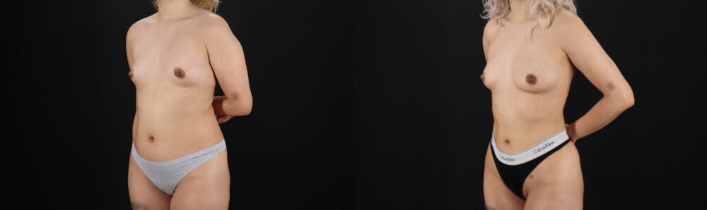 Liposuction case #6020