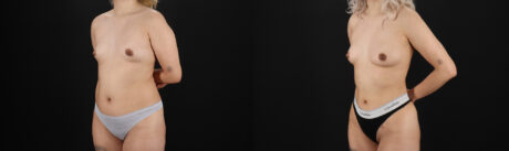 Liposuction case #6020