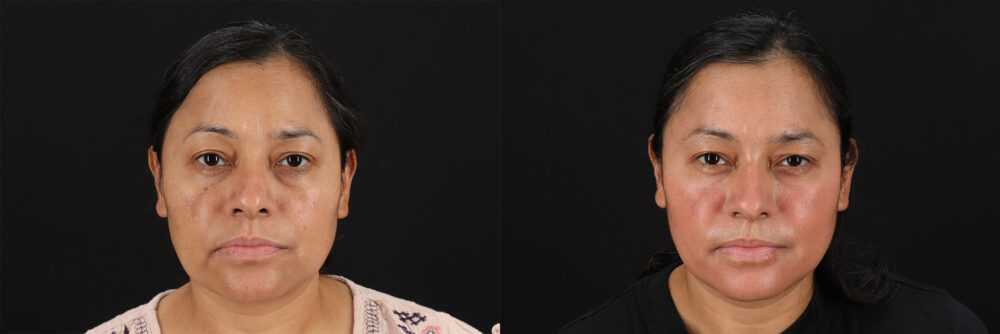 Cosmelan Chemical Peel case #5081