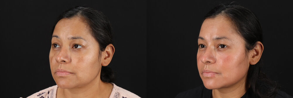 Cosmelan Chemical Peel case #5081