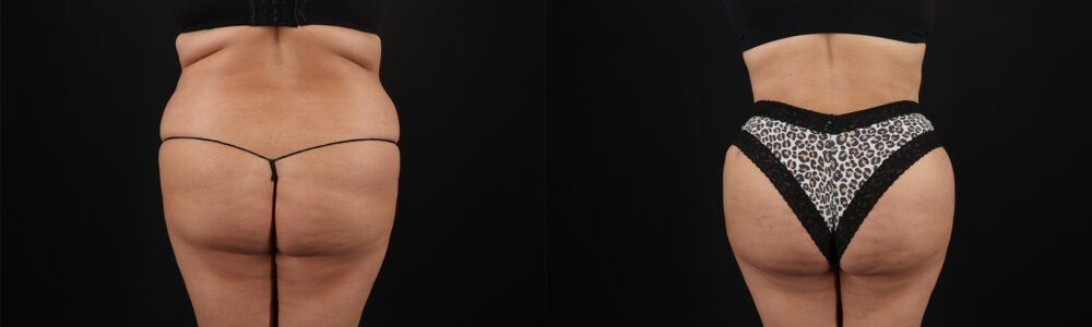 Brazilian Butt Lift case #5267