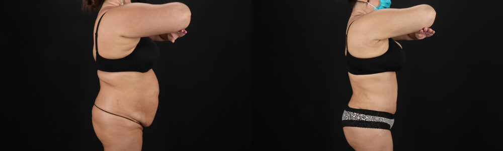 Brazilian Butt Lift case #5267