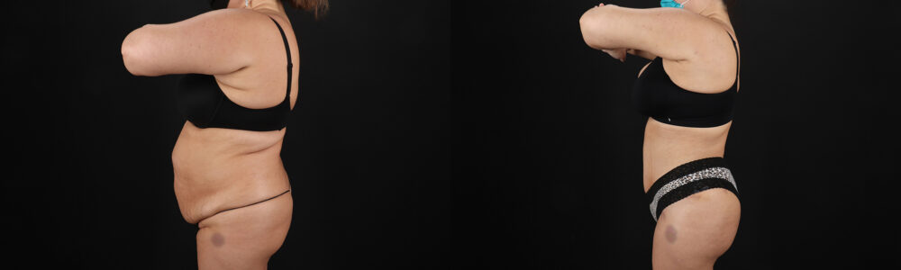 Brazilian Butt Lift case #5267