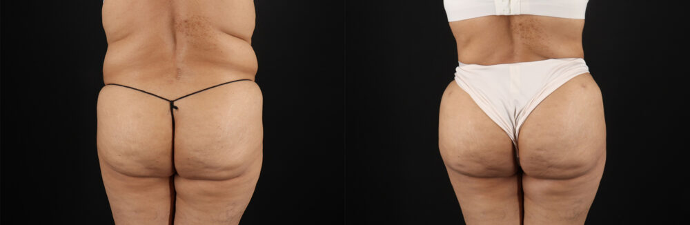Liposuction case #6111