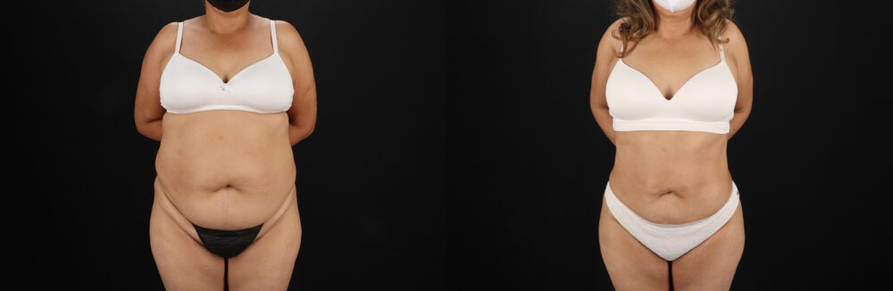 Liposuction case #6111