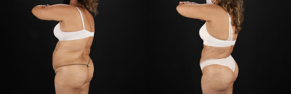 Liposuction case #6111