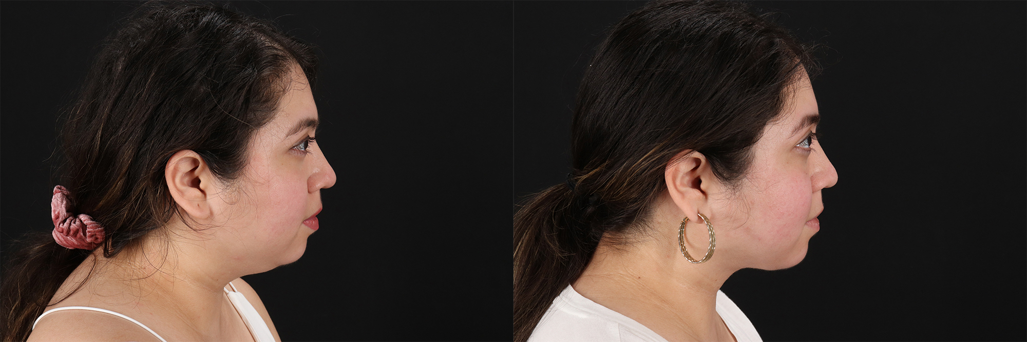 14694-43576-Submental-Liposuction-before-and-after-photo-by-Dr.-Erika-A.-Sato-in-Houston-TX