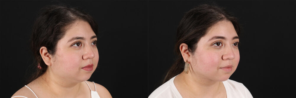 Submental Liposuction case #6953