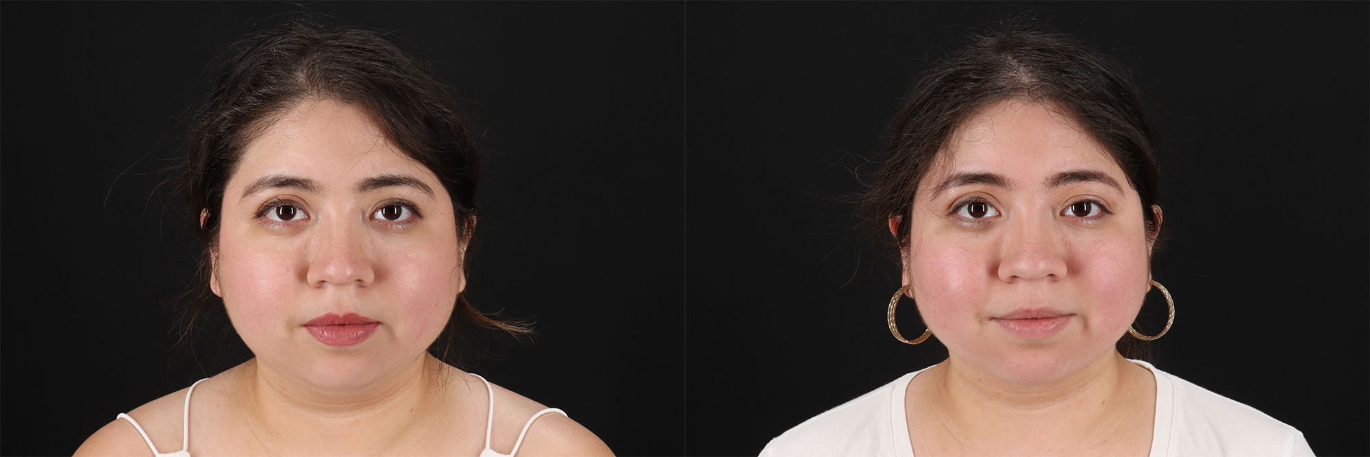 14694-67208-Submental-Liposuction-before-and-after-photo-by-Dr.-Erika-A.-Sato-in-Houston-TX