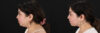 Submental Liposuction case #6953 slider thumbnail