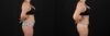 Liposuction case #6112 slider thumbnail
