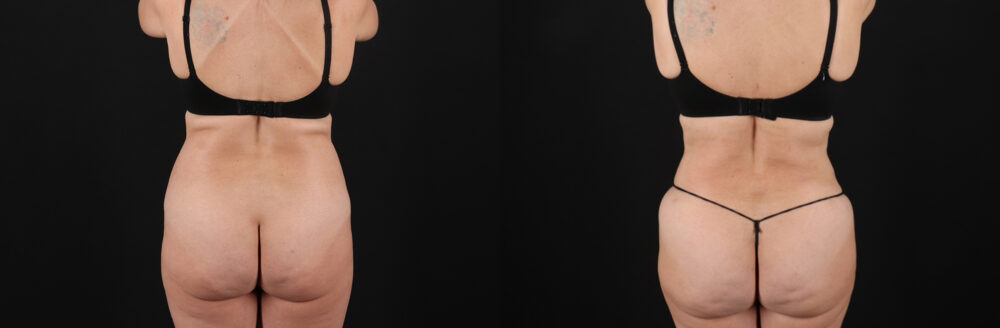 Liposuction case #6112