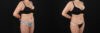 Liposuction case #6112 slider thumbnail