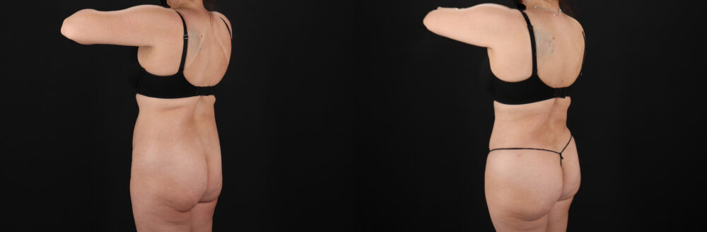 Liposuction case #6112