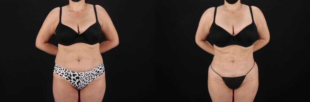 Liposuction case #6112