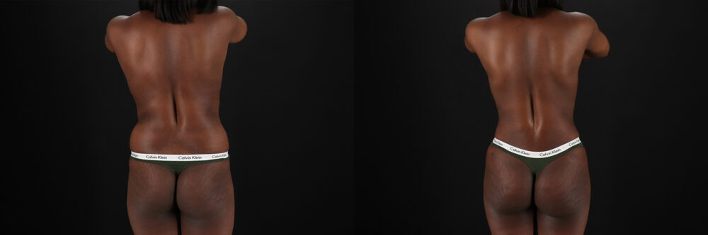 Mommy Makeover case #6524