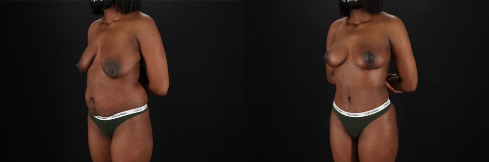 Mommy Makeover case #6524