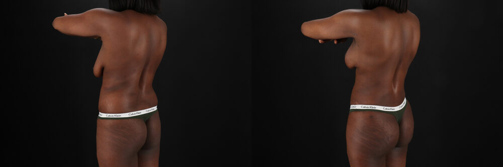 Mommy Makeover case #6524