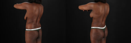 Mommy Makeover case #6524