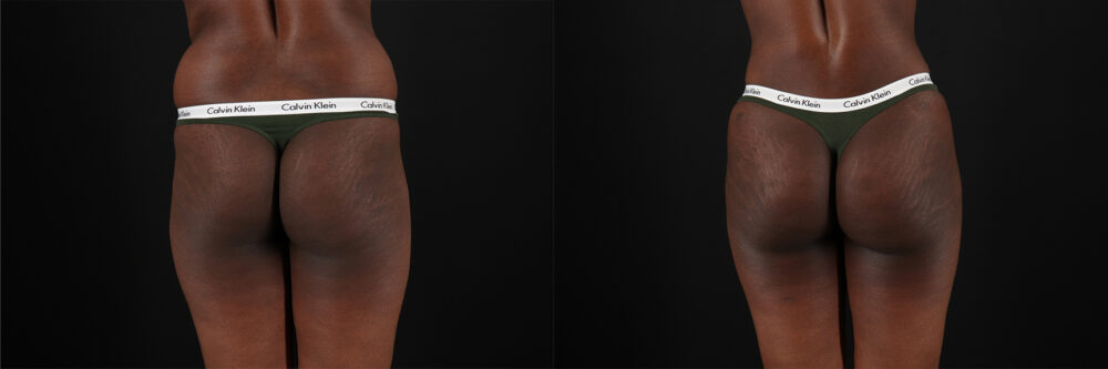 Mommy Makeover case #6524