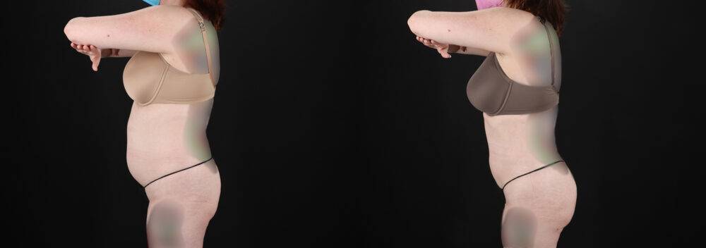 Liposuction case #6019