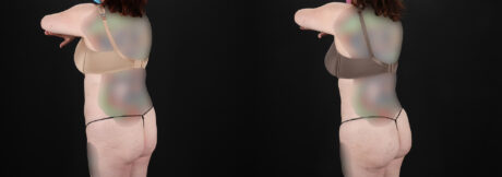 Liposuction case #6019