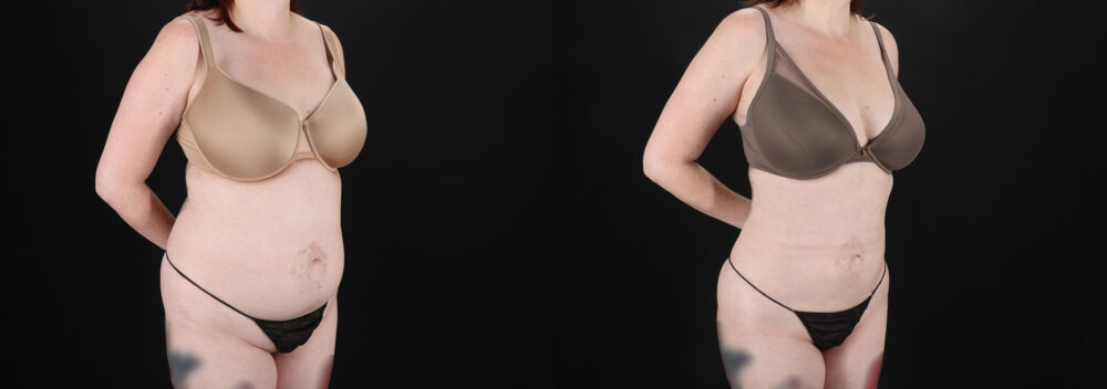 Liposuction case #6019