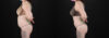 Liposuction case #6019 slider thumbnail