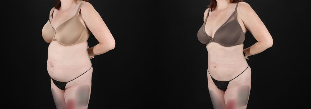 Liposuction case #6019