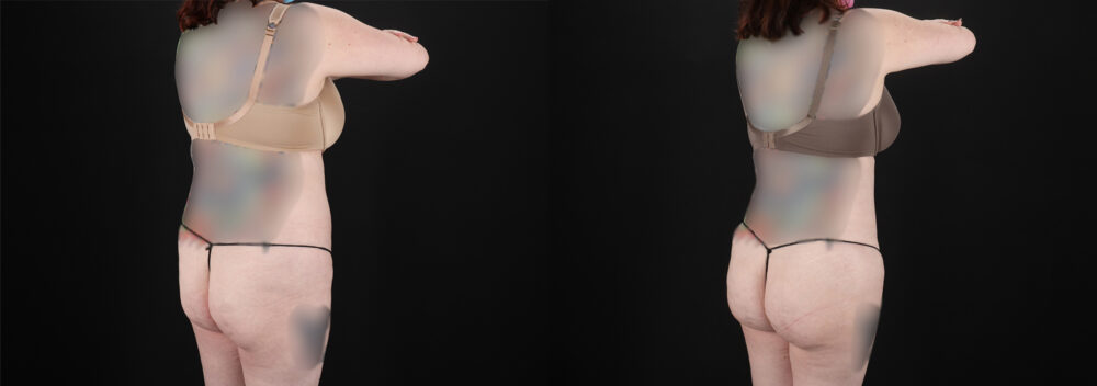 Liposuction case #6019