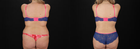 Tummy Tuck case #7775