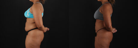 Brazilian Butt Lift case #5513