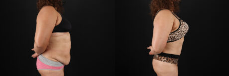 Tummy Tuck case #7467