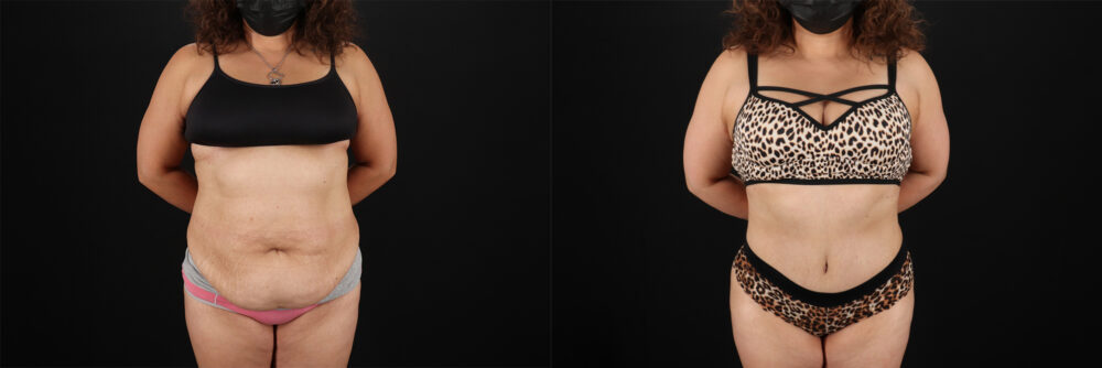 Tummy Tuck case #7467