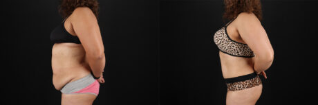 Tummy Tuck case #7467