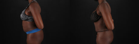 Tummy Tuck case #7466