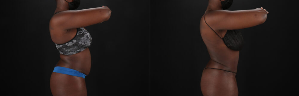 Tummy Tuck case #7466