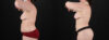 Liposuction case #6117 slider thumbnail