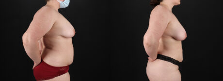 Liposuction case #6117