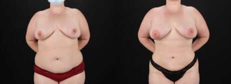 Liposuction case #6117