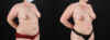 Liposuction case #6117 slider thumbnail