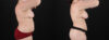 Liposuction case #6117 slider thumbnail