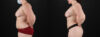 Liposuction case #6117 slider thumbnail
