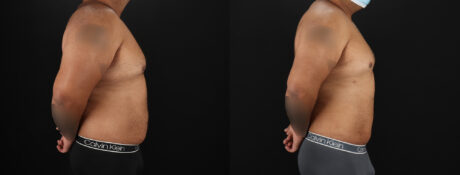 Liposuction case #6116