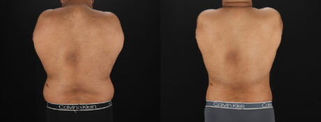 Liposuction case #6116